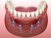 Permanent Dentures | White Lily Dental