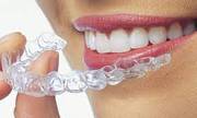 Teeth Aligners | White Lily Dental