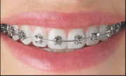 Ortho Treatment For Teeth | White Lily Dental