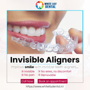 Invisible Dental Aligners | White Lily Dental
