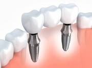 Basal Implants in Gurgaon | White Lily Dental